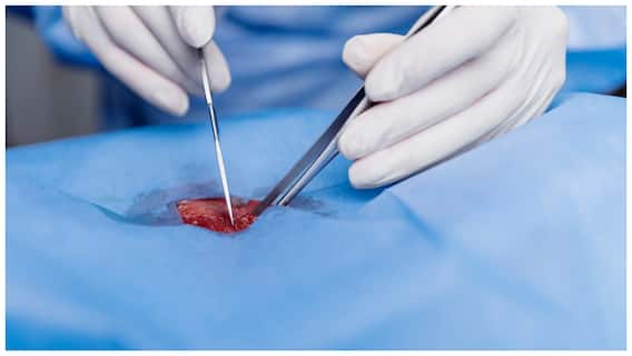 Narasaraopet Crime News: నరసరావుపేట ప్రభుత్వ ఆసుపత్రిలో దారుణం- ఆపరేషన్ చేసి కడుపులో సర్జికల్  బ్లేడు వదిలేసిన వైద్యులు