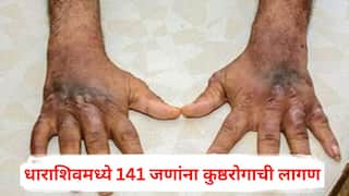 Leprosy News : धाराशिवमध्ये 141 जणांना कुष्ठरोगाची लागण; जिल्ह्यात पंधरा लाख लोकांची तपासणी
