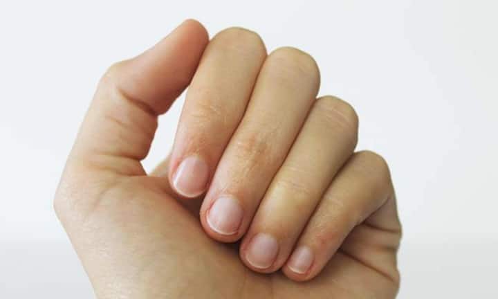 इसके अलावा कोइलोनिखिया यानी स्पून नेल्स आयरन डेफिशियेंसी एनीमिया का शुरुआती संकेत होता है. इसमें नाखून इतने पतले हो जाते हैं कि उनकी सतह अंदर की ओर धंस जाती है और चम्मच जैसी दिखाई देती है. इसे लेकर एक्सपर्ट्स बताते हैं कि यह आयरन की कमी, भारी पीरियड्स, गर्भावस्था, पोषण की कमी या फिर किसी गंभीर बीमारी का संकेत हो सकता है. खास बात यह है कि यह नाखूनों में बदलाव कई बार अन्य लक्षणों से महीनाें पहले दिखाई देते हैं.