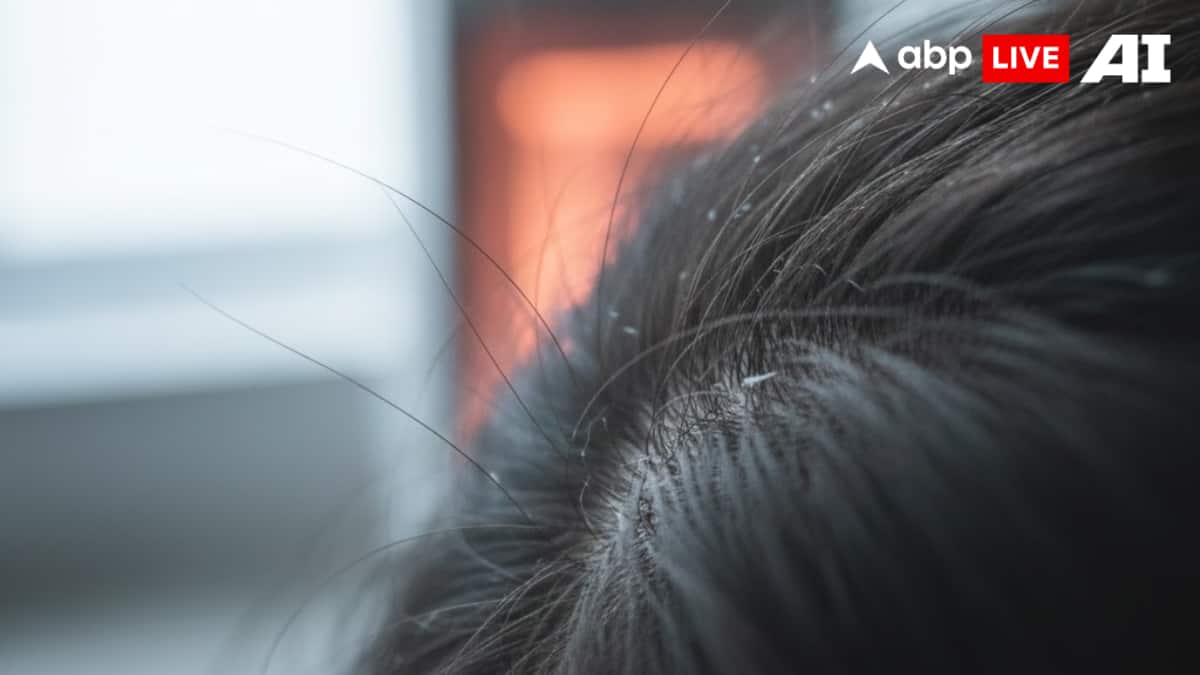 Why Dandruff Peaks In Winter And The Smart Scalp Care That Prevents It