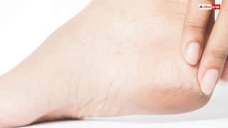 सर्दियों में फटी एड़ियों से हो गए हैं परेशान, तो घर पर ही बनाएं ये बेहतरीन क्रीम