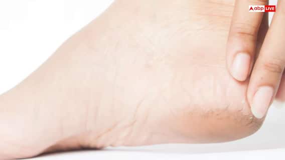 सर्दियों में फटी एड़ियों से हो गए हैं परेशान, तो घर पर ही बनाएं ये बेहतरीन क्रीम