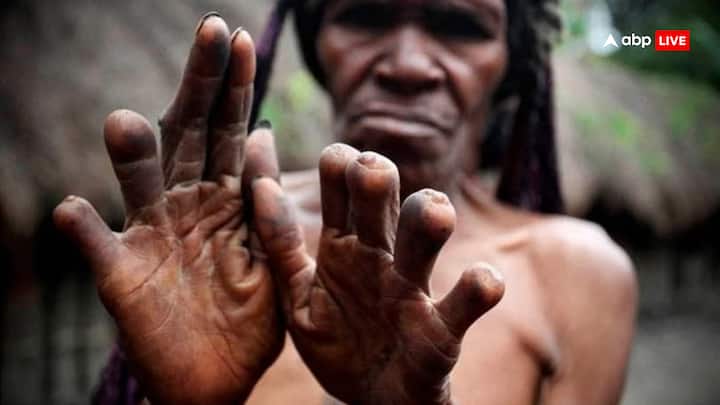 पापुआ न्यू गिनी में कुछ परिवार अपने किसी करीबी की मौत के बाद उंगलियों का कुछ हिस्सा काटकर दुख जताते हैं.