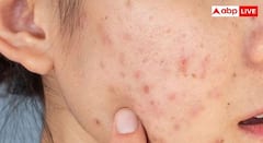 Skin Care: ખીલના કારણે થયેલા ખાડાને આ રીતે કરો રિપેર, જાણો ઘરેલુ ઉપાય