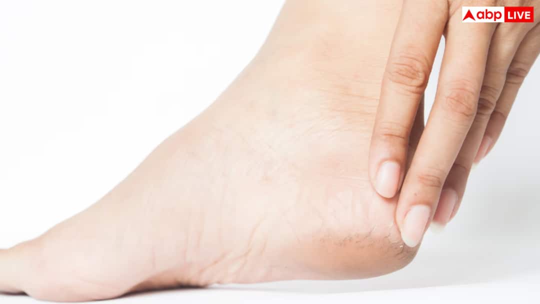 hacks home remedies for cracked heels in winter सर्दियों में फट रही हैं आपकी एड़ियां तो न हों परेशान, ये नुस्खे आएंगे बड़े काम