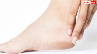 Cracked Heels in winter: શિયાળામાં એડી ફાટી જાય છે? આ ઘરેલુ ઉપાય છે રામબાણ ઇલાજ