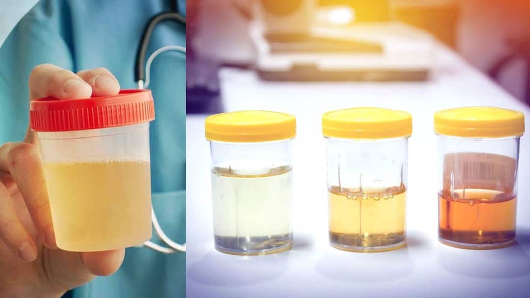 Urine color identification to signs you are in danger situation Urine Infection: உங்க சிறுநீர் இந்த கலரில் இருந்தால் ஆபத்து.. உடனே செக் பண்ணுங்க!