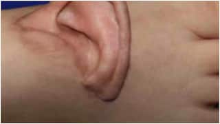 Shocking Surgery : ప్రమాదంలో చెవి తెగిపోతే కాలికి అతికించిన వైద్యులు.. ఈ Medical Miracle ఎక్కడ జరిగిందంటే