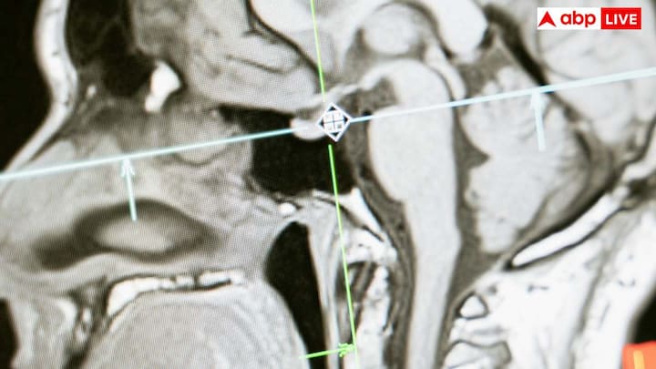 जब हम पर्याप्त मात्रा में पानी नहीं पीते और शरीर में डिहाइड्रेशन बढ़ जाता है, तो खून में नमक और अन्य तत्वों की मात्रा बढ़ जाती है. इससे खून गाढ़ा हो जाता है. खून को पतला करने के लिए शरीर दिमाग की कोशिकाओं से पानी खींचना शुरू कर देता है. जैसे ही कोशिकाओं से पानी निकलता है, दिमाग का आकार सिकुड़ने लगता है.