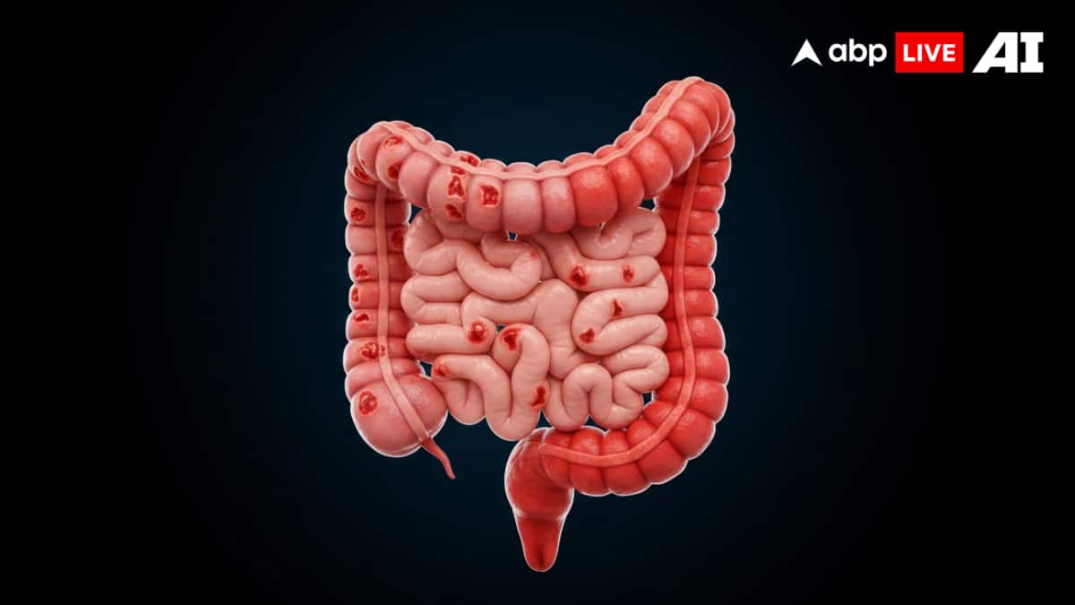 Crohn’s Disease vs Ulcerative Colitis: Symptoms, Detection, Treatment, And What Every Patient Should Know