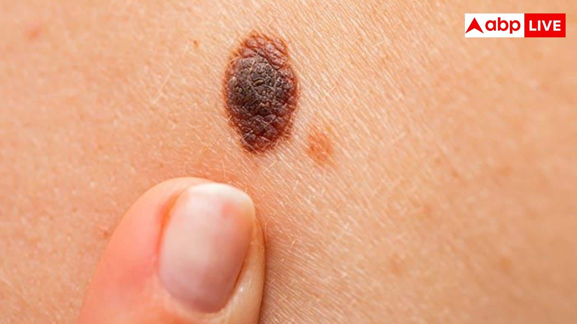 शरीर पर क्यों हो जाते हैं बहुत सारे तिल, क्या होती है इसकी वजह