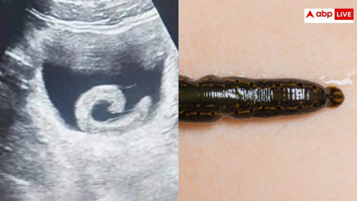 ऑनलाइन इलाज पर भरोसा पड़ा भारी, युवक ने शरीर में ऐसी जगह डाली जोंक कि अस्पताल में मचा हड़कंप- यूजर्स हैरान