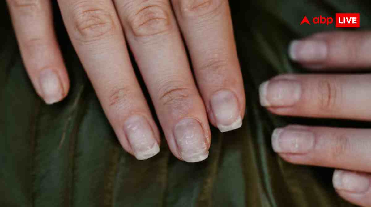 नाखूनों में काली लाइन दिखे तो न करें नजरअंदाज, हो सकता है स्किन कैंसर का संकेत