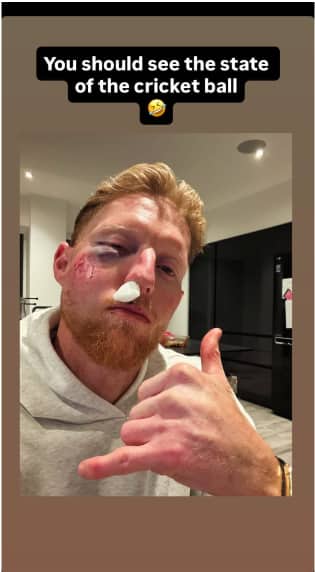 You Should See State Of The Ball': Ben Stokes Finds Humor Despite Graphic Facial Injuries