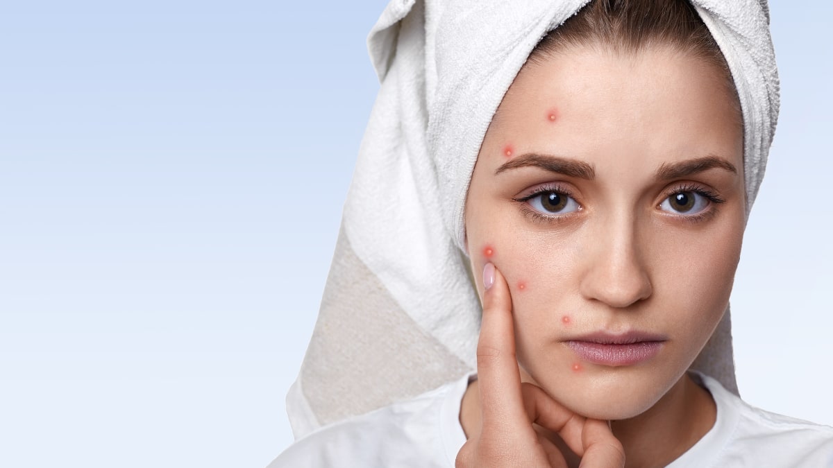 Acne-Prone Skin? Here’s How To Prepare Your Skin For Summer Now
