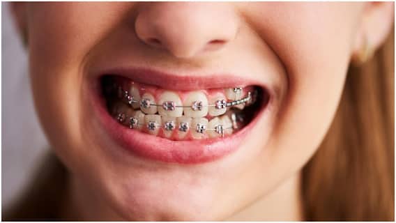Kiss with Braces : బ్రేసెస్ పెట్టుకుని ఫ్రెంచ్ కిస్ చేయవచ్చా? లేదా? ఒకవేళ ముద్దు పెట్టుకుంటే.. Kiss with Braces : బ్రేసెస్ పెట్టుకుని ఫ్రెంచ్ కిస్ చేయవచ్చా? లేదా? ఒకవేళ ముద్దు పెట్టుకుంటే..