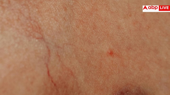 শরীরে ফোলাভাব, অর্থাৎ এডিমা (edema), কিডনি বিকলের একটি গুরুত্বপূর্ণ লক্ষণ হতে পারে। সাধারণত পা, গোড়ালি, হাত বা মুখে এই ফোলাভাব দেখা যায়। আক্রান্ত স্থানের ত্বক টানটান বা অস্বাভাবিকভাবে উজ্জ্বল দেখাতে পারে, যা শরীরে অতিরিক্ত তরল জমার ইঙ্গিত দেয়।