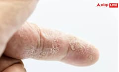 ਸਕਿਨ 'ਤੇ ਨਜ਼ਰ ਆਉਣ ਆਹ ਲੱਛਣ ਤਾਂ ਹੋ ਜਾਓ Alert, ਨਹੀਂ ਤਾਂ ਖਰਾਬ ਹੋ ਜਾਵੇਗੀ Kidney