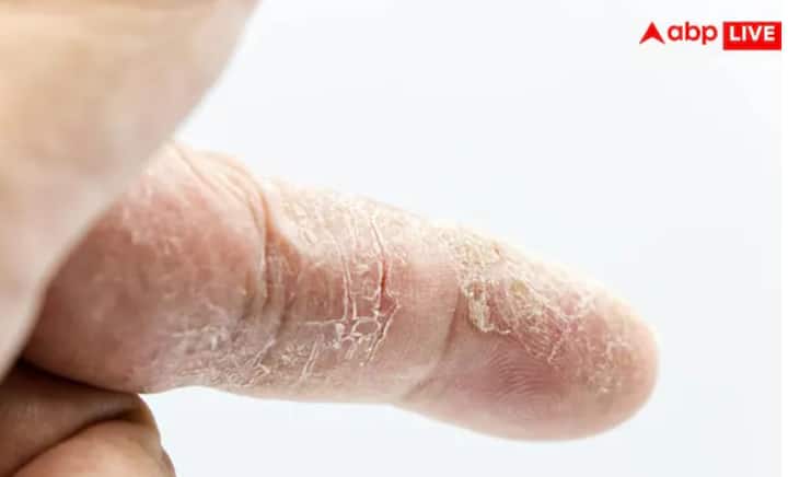 ਕਿਡਨੀ ਦੀ ਬਿਮਾਰੀ ਦੇ ਸਭ ਤੋਂ ਆਮ ਲੱਛਣਾਂ ਵਿੱਚੋਂ ਇੱਕ ਚਮੜੀ ਦਾ ਬਹੁਤ ਜ਼ਿਆਦਾ ਖੁਸ਼ਕੀ ਹੋਣਾ ਹੈ। ਚਮੜੀ ਖੁਰਦਰੀ, ਪਪੜੀਦਾਰ ਅਤੇ ਖਿਚੀ ਹੋਈ ਮਹਿਸੂਸ ਹੋ ਸਕਦੀ ਹੈ। ਕਈ ਵਾਰ ਇਹ ਫਟ ਸਕਦੀ ਹੈ ਅਤੇ ਮੱਛੀ ਵਰਗੀ ਦਿਖਾਈ ਦੇ ਸਕਦੀ ਹੈ।