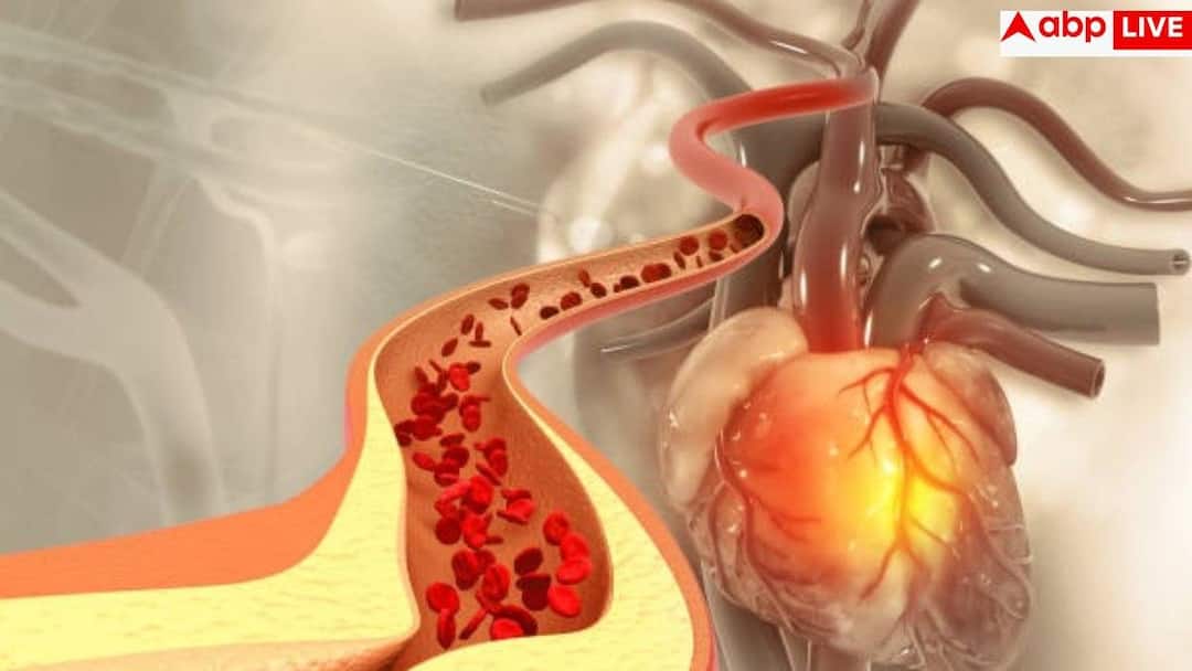 हाई कोलेस्ट्रॉल: इस दवा से मिलती है राहत, नई स्टडी में हुआ खुलासा
