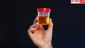 Blood In Urine : ਜੇਕਰ ਪਿਸ਼ਾਬ 'ਚ ਆ ਰਿਹਾ ਖੂਨ ਤਾਂ ਹੋ ਸਕਦਾ ਹੈ ਕੈਂਸਰ , ਤੁਰੰਤ ਕਰਵਾਓ ਇਹ ਟੈਸਟ