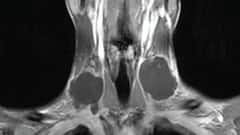 Medical Science News: রঙিন ট্যাটু করানোই কাল হল, গলা ফুলে ঢোল তরুণের, শেষে অস্ত্রোপচার করতে হল