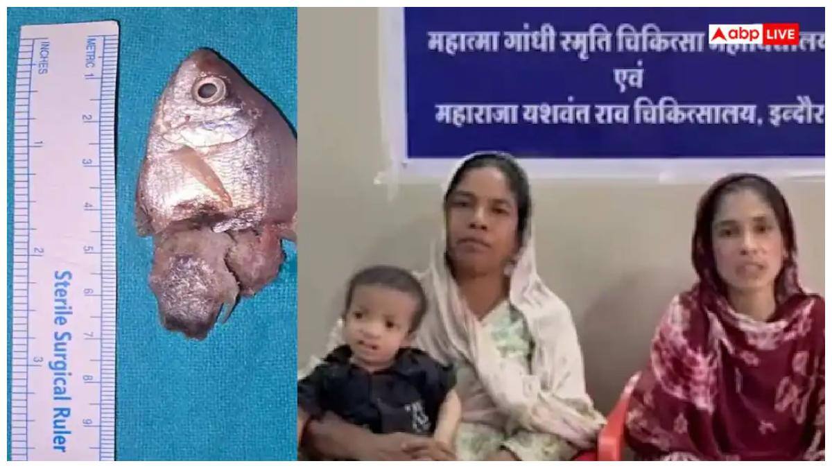 MP Viral News: ఏడాదిన్నర బాలుడి గొంతులో ఎగిరిపడ్డ చేప! ఆపరేషన్ చేసి ప్రాణాలు కాపాడిన వైద్యులు!