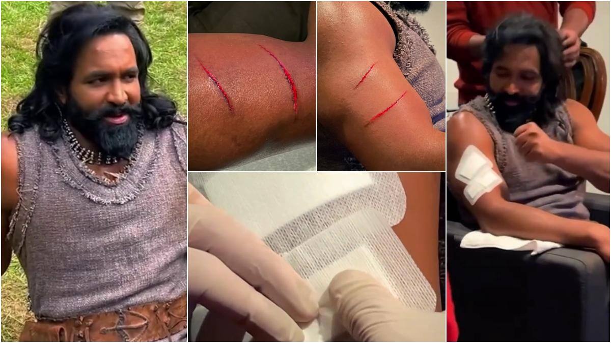Vishnu Manchu: గాయం మానింది కానీ గుర్తులు చెరిగిపోలేదు... మంచు విష్ణు