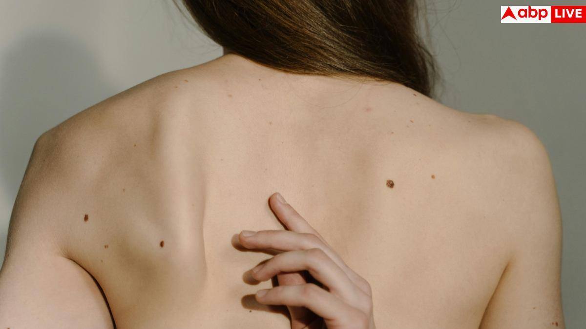 Melanoma Cases In UK: शरीर के तिलों को कतई न करें इग्नोर, बढ़ रहा है स्किन कैंसर का खतरनाक रूप