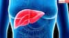 ਸ਼ਹਿਰੀ ਭਾਰਤ 'ਚ ਹਰ ਤੀਜਾ ਵਿਅਕਤੀ Fatty Liver ਦਾ ਸ਼ਿਕਾਰ, ਨਜ਼ਰਅੰਦਾਜ਼ ਕੀਤਾ ਤਾਂ ਹੋ ਸਕਦਾ ਕੈਂਸਰ
