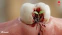 Tomato Seed Sprouting inside Mouth: দাঁতে টমেটোর বীজ আটকে তীব্র যন্ত্রণা, রুট ক্যানাল করতে গিয়ে হতভম্ব ডেন্টিস্ট, রোগীর মুখ থেকে বেরোল চারাগাছ