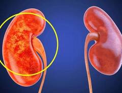 Kidney ਖਰਾਬ ਹੋਣ ਦੇ ਸ਼ੁਰੂਆਤੀ 10 ਲੱਛਣ