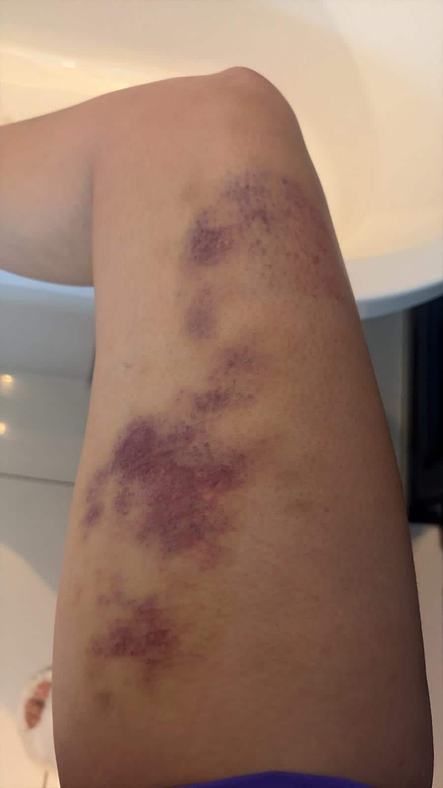 Shagun Sharma's condition was like this during the shooting of 'Khatron Ke Khiladi 15', she got injuries on her body, photos went viral.