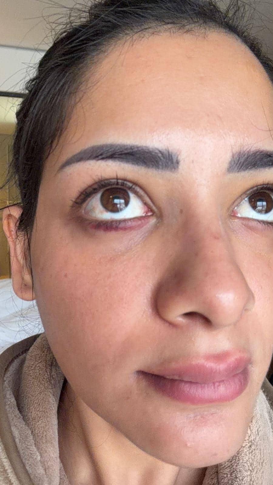 Shagun Sharma's condition was like this during the shooting of 'Khatron Ke Khiladi 15', she got injuries on her body, photos went viral.