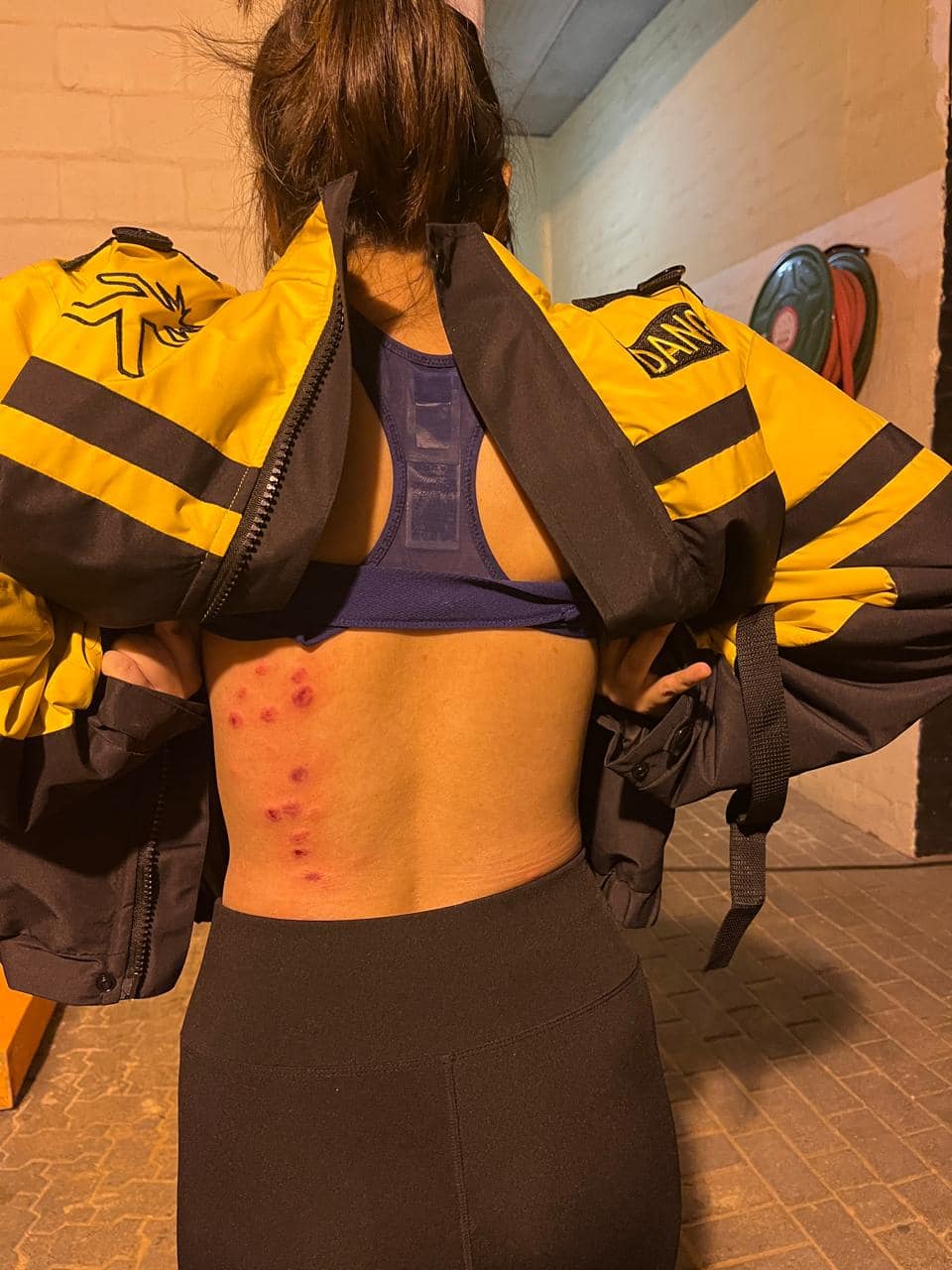 Shagun Sharma's condition was like this during the shooting of 'Khatron Ke Khiladi 15', she got injuries on her body, photos went viral.