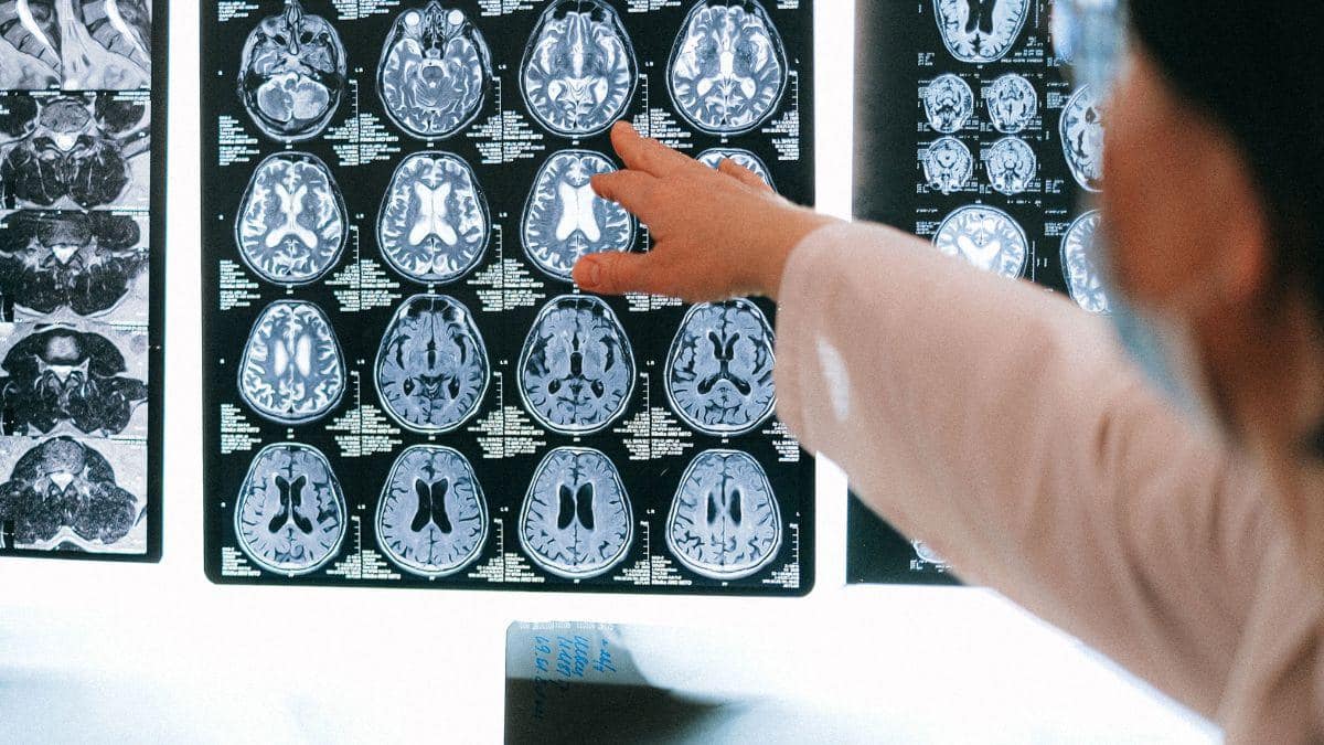 Could Staying Up Late Increase Risk Of A Mini Stroke? Experts Warn Against Chronic Sleep Deprivation