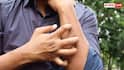 Bug Bite Itching: मच्छर या कीड़ा काटे तो खुजली करने से पहले 2 बार सोचें, रिसर्च में हुआ बेहद चौंकाने वाला खुलासा