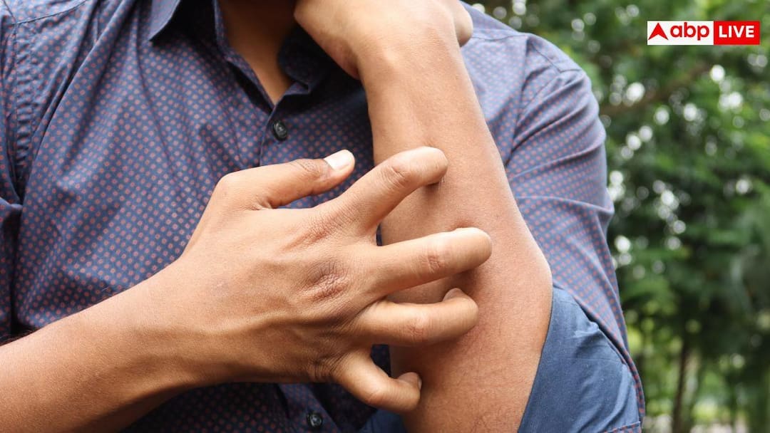If bitten by a mosquito or insect, think twice before itching, a very shocking revelation was made in the research.