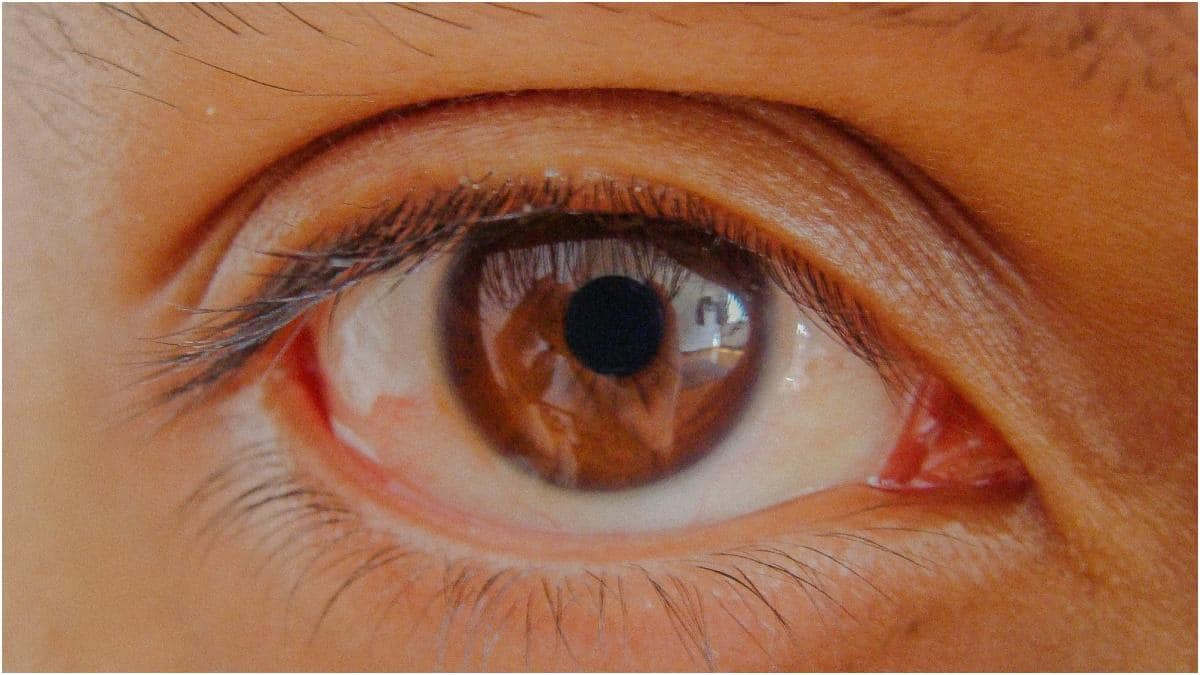 Conjunctivitis : కండ్లకలక ఎందుకు వస్తుంది? లక్షణాలు, తీసుకోవాల్సిన జాగ్రత్తలు, ఇంటి చిట్కాలు, చికిత్స ఇవే