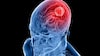 Brain Tumor Treatment: ਬ੍ਰੇਨ ਟਿਊਮਰ ਦੇ ਇਲਾਜ 'ਚ ਵੱਡੀ ਸਫਲਤਾ, ਜਾਨਲੇਵਾ ਬਿਮਾਰੀ ਨੂੰ ਠੀਕ ਕਰੇਗੀ ਇਹ ਦਵਾਈ; ਵਿਗਿਆਨੀ ਬੋਲੇ- 'ਮਰੀਜ਼ਾਂ ਦੀ ਉਮਰ 22 ਮਹੀਨਿਆਂ ਤੱਕ...'