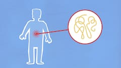 Cyclospora Infection Is Spreading Rapidly; Know Why It Causes Severe Diarrhoea