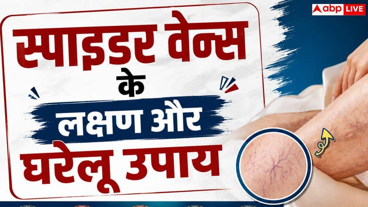 Spider Veins: आपके पापा के पैर में दिख रहे मकड़ी जैसे जाले, कितनी गंभीर है यह समस्या?