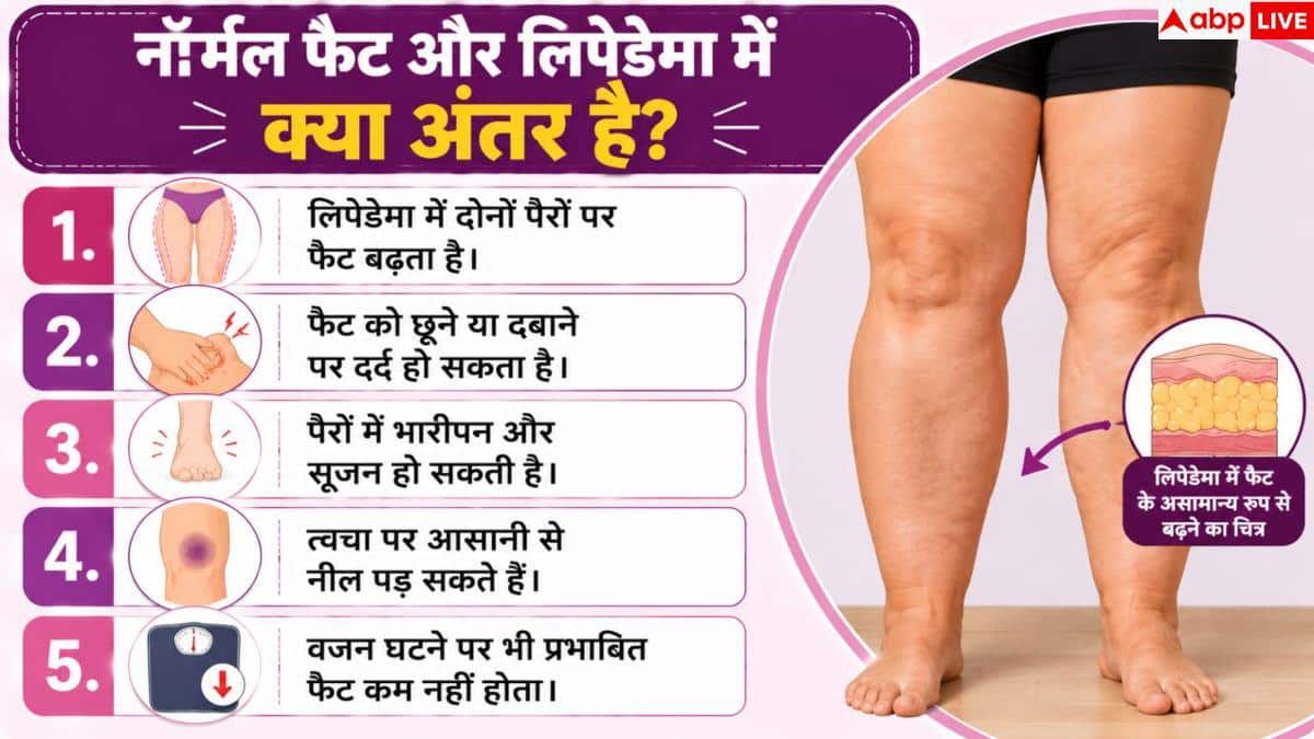 Lipedema Symptoms: जांघ की चर्बी को न मान लेना नॉर्मल फैट, हो सकती है यह बीमारी