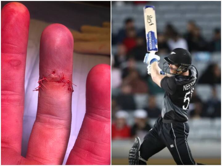 Jimmy Neeshan Undergoes Surgery For Compound Dislocation On His Finger Kings XI Punjab All-Rounder Undergoes Surgery For Compound Dislocation On His Finger