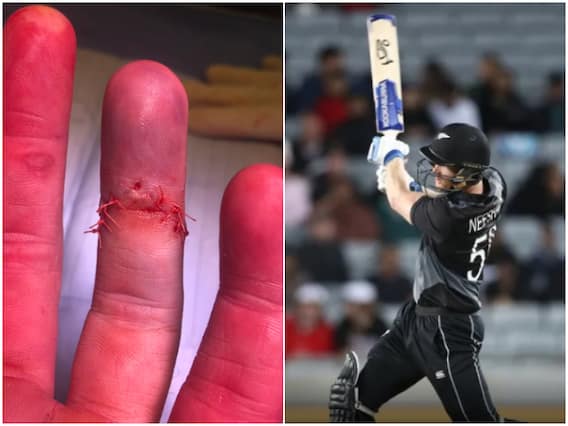 Kings XI Punjab All-Rounder Undergoes Surgery For Compound Dislocation On His Finger Kings XI Punjab All-Rounder Undergoes Surgery For Compound Dislocation On His Finger